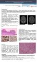 PosterXXXVSEAP008 - Metástasis leptomeníngea de carcinoma urotelial de alto grado. Presentación de un caso.