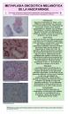 PosterXXXVSEAP011 - Metaplasia oncocítica melanótica de la nasofaringe