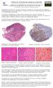 PosterXXXVSEAP013 - Tumor de colisión en glándula parótida