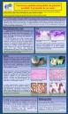 PosterXXXVSEAP016 - Carcinoma epitelial-mioepitelial de glándula parótida: A propósito de un caso