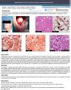 PosterXXXVSEAP017 - RABDOMIOMA TIPO ADULTO EN SUELO DE BOCA: A PROPÓSITO DE UN CASO