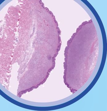 Plataforma de formación en Diagnóstico de Mastocitosis Sistemica