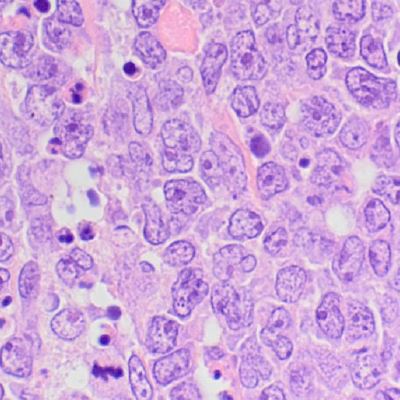 Lymphoma/Leukemia, diagnosis for targeted therapy 2022