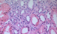 III Jornada de Patología del Hospital Universitario Cruces. El patólogo y el trasplante renal