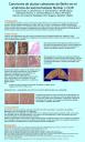 Carcinoma de ductos colectores de Bellini en el síndrome de leiomiomatosis hereditaria y CCR.