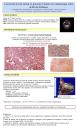 Carcinoma ductal salival en paciente tratado con radioterapia sobre anillo de Waldeyer