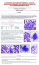 Carcinoma sebáceo de glándula salival. Análisis clínicomorfológico de tres casos de un tumor poco frecuente.