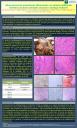 Adenocarcinoma pobremente diferenciado con extensa infiltración linfoide (carcinoma medular) asociado a esófago de Barret