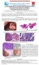 Carcinoma Mixto Adeno-Neuroendocrino de Intestino Grueso (MANEC). Presentación de un caso.
