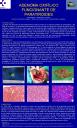 Adenoma Oxifílico Funcionante de Paratiroides (A propósito de un caso)