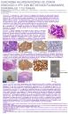 Carcinoma Neuroendocrino de cérvix con metástasis pulmonares, cerebrales y cutáneas asociado a VPH
