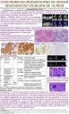 Carcinoma Neuroendocrino de origen desconocido en mujer de 19 años
