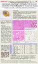 Carcinoma infiltrante de mama con células gigantes tipo osteoclasto: Revisión de 10 casos.