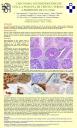 Carcinoma neuroendocrino de célula pequeña de cérvix uterino: a propósito de un caso.