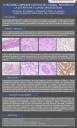 Carcinoma adenoide quistico de la mama: Revision de la literautra y claves diagnosticas.