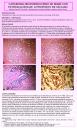 Carcinoma neuroendocrino de mama con patrón alveolar. A propósito de un caso.