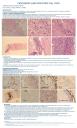 Carcinoma Tímico Sarcomatoide