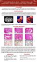 Angiosarcoma renal en una mujer: A propósito de un caso.
