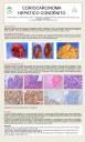 coriocarcinoma hepático congénito