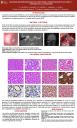 Adenoma del oído medio con diferenciación neuroendocrina. Presentación de un caso revisión de la literatura