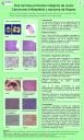 Dos tumores primarios malignos de úvula: Carcinoma linfoepitelial y sarcoma de Kaposi