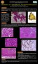 Carcinoma de células acinares con tres variantes morfológicas