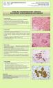 Displasia neuroendocrina  en paciente con enfermedad autoinmune