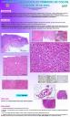 Carcinoma micropapilar primario de colon, a propósito de un caso