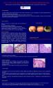 Colitis colágena pseudomembranosa