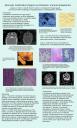 Abscesos cerebrales fúngicos en pacientes inmunocompetentes