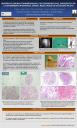 Biopsia pulmonar transbronquial con criosonda en el diagnóstico de la enfermedad pulmonar intersticial difusa: Resultados de un estudio piloto